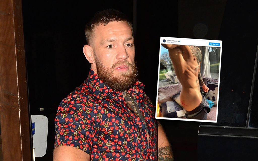 Conor McGregor jäi auton alle – Julkaisi kuvan rujosta pakarastaan