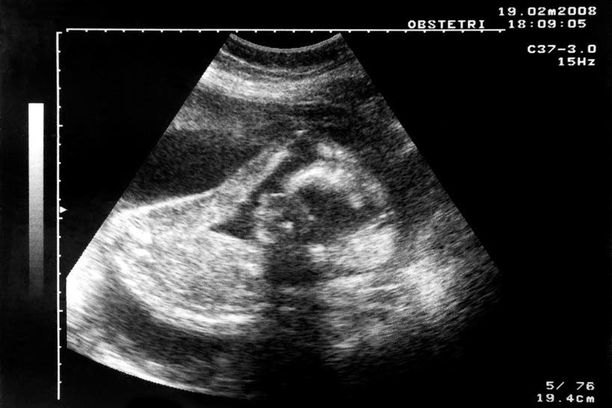 Kun raskaus on edennyt yli 12. raskausviikon, on aborttiin saatava lääkärin päätöksen lisäksi lupa Valviralta. Kuvituskuva.