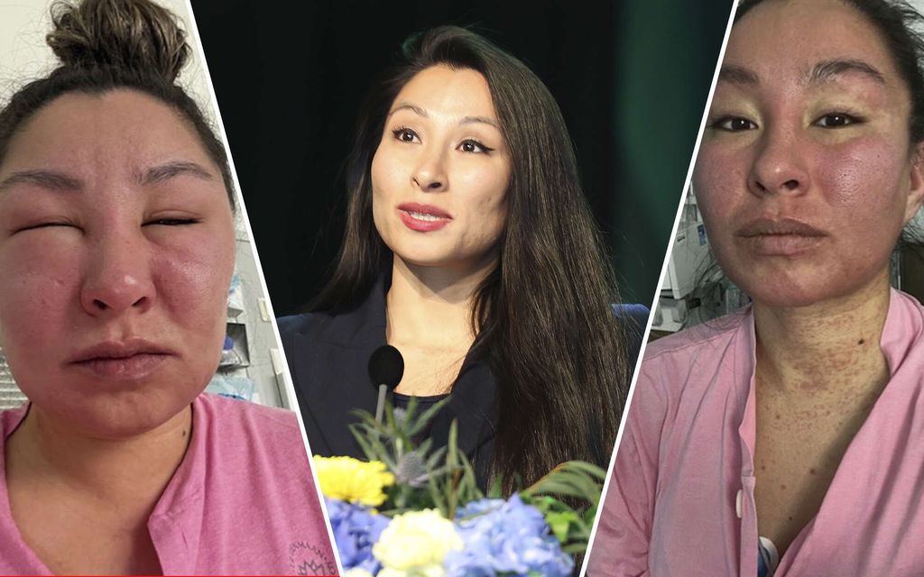 ”Kaikki kynteni tippuivat pois” –  Eva sai hengen­vaarallisen reaktion lääkkeestä