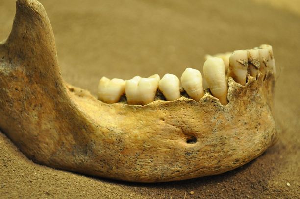 Illustration picture.  The jawbone in the picture is not related to the case.