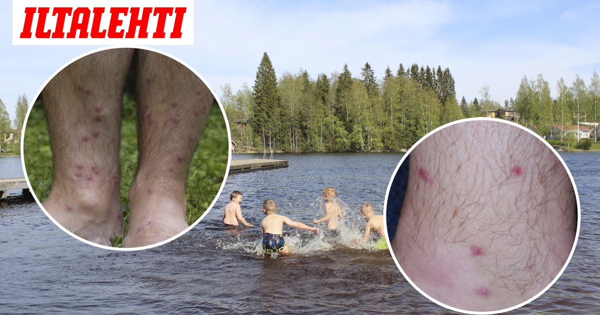 Järvisyyhy: oireet ja hoito - Vimarsana News