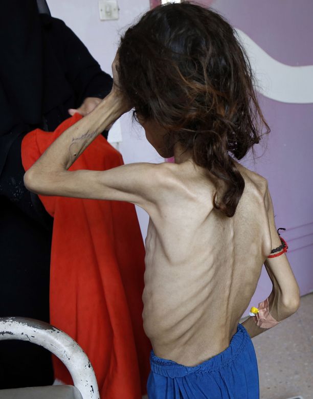 Jemenissä on meneillään humanitaarinen kriisi, jota Saudi-Arabian mukanaolo syventää. Viime torstaina sanaalaisessa sairaalassa otetussa kuvassa poseeraa Sadia Ibrahim, 11 vuotta ja 12 kiloa.