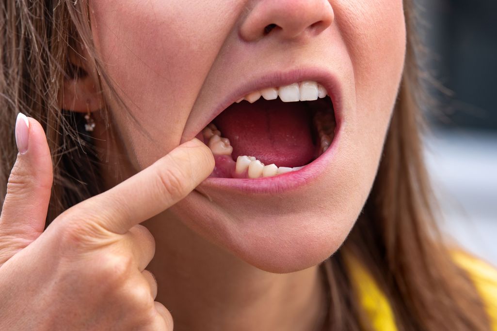 Ihmisiltä putoavat hampaat suusta – New York Times: Koronaviruksen mahdollinen sivuoire