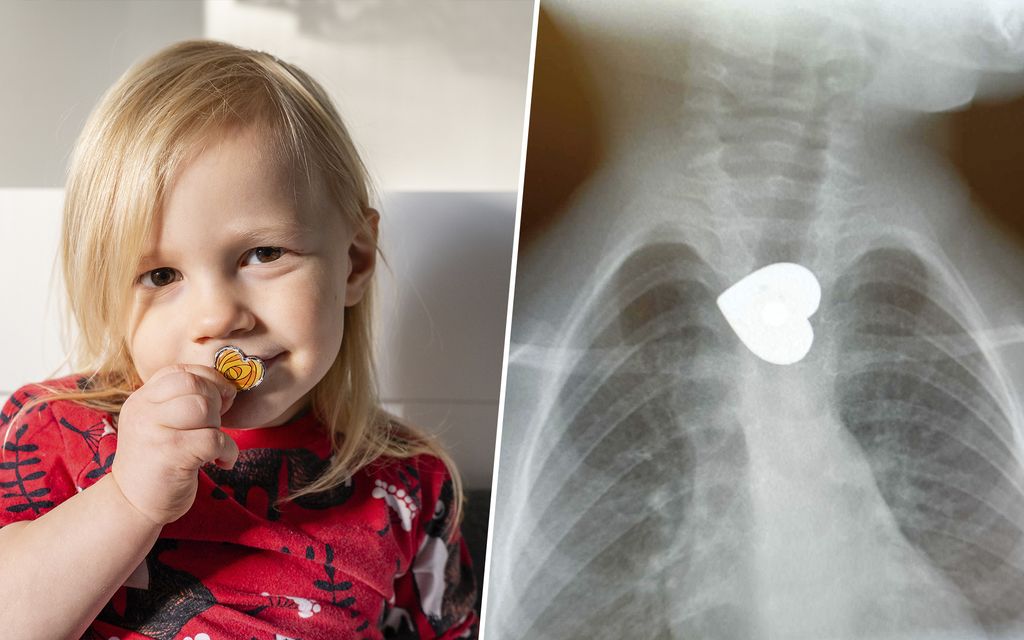 2-vuotias Roni nielaisi 2,5 senttimetrin magneetin – Lääkärissä paljastui uskomaton kuva