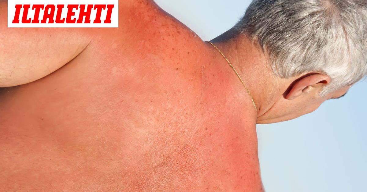 Mita Aurinko Tekee Iholle Kuvat Nayttavat Kuinka Pahaa Jalkea Aurinko Voi Saada Aikaan