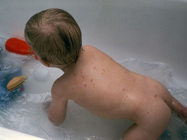Tuhkarokkotapausten yleistyminen selittyy rokotevastaisuuden lisääntymisellä.