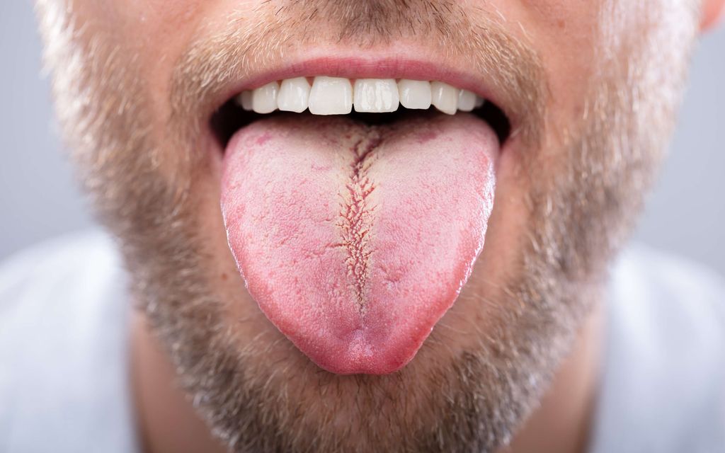 Pieni muutos kielessä voi olla merkki vakavasta sairaudesta – Tunnista ajoissa