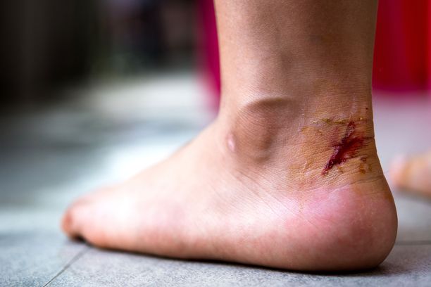 Jalassa olevaan haavaan voi päästä multaa tai hiekkaa, jossa on tetanuksen aiheuttavaa bakteerin myrkkyä.