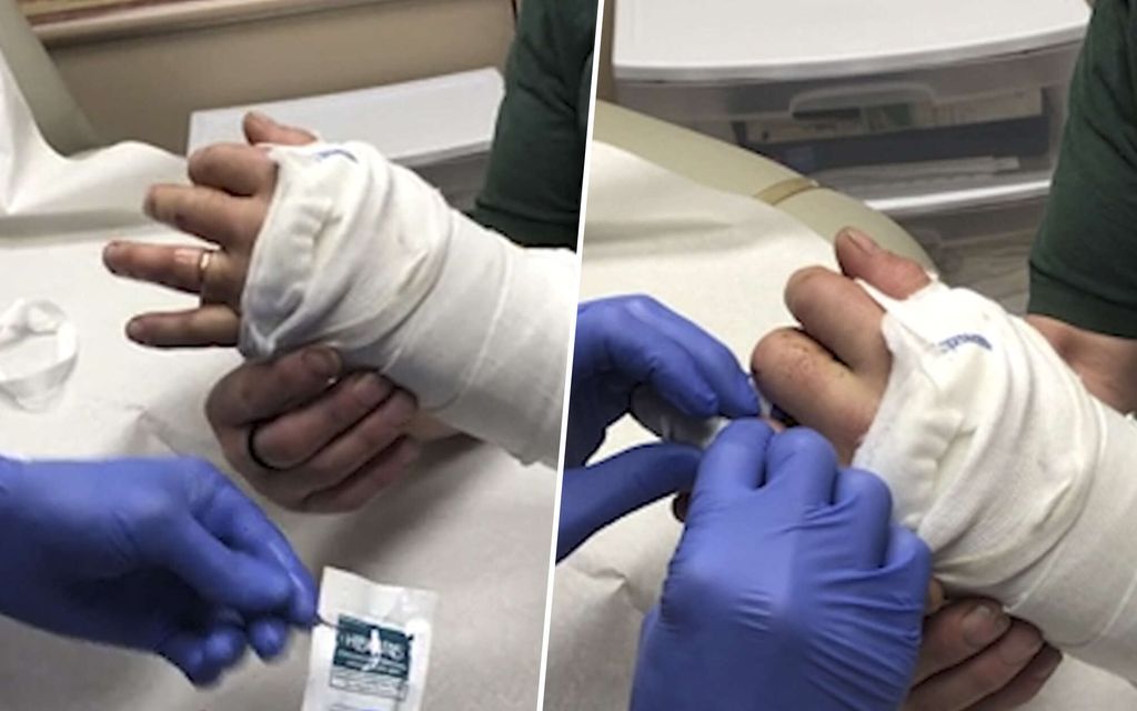 Videosta tuli somehitti: Näin kirurgi poisti sormuksen USA:ssa