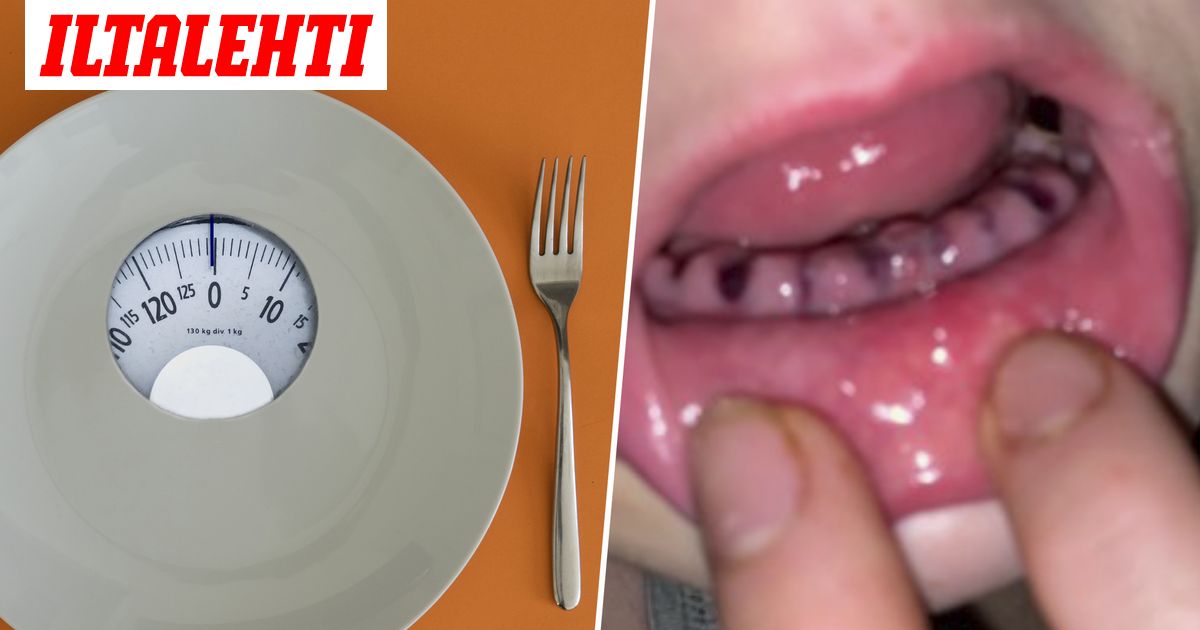 Syömishäiriön vaikutukset hampaisiin