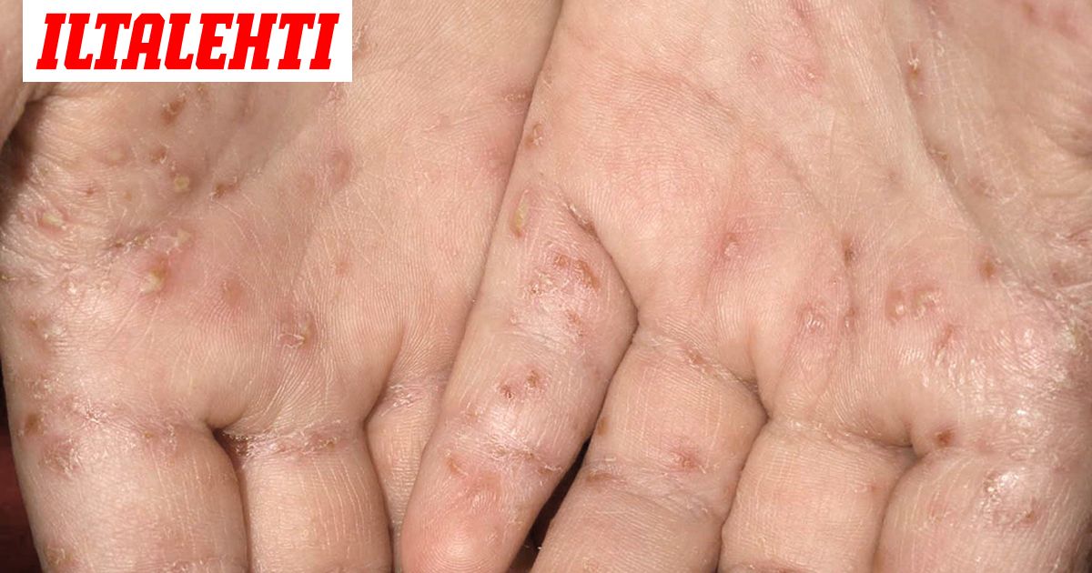 Laakari Punkkisyyhy Lisaantynyt Kutisevaa Tautia Ei Enaa