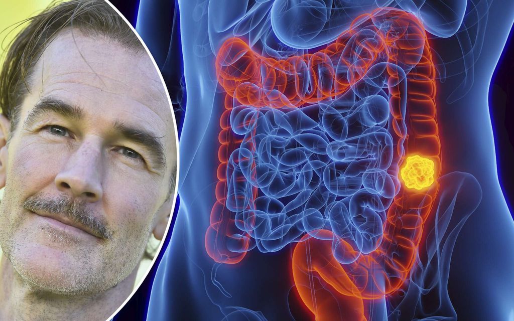 Tällaista syöpää James Van Der Beek sairasti – Alkuvaihe usein oireeton