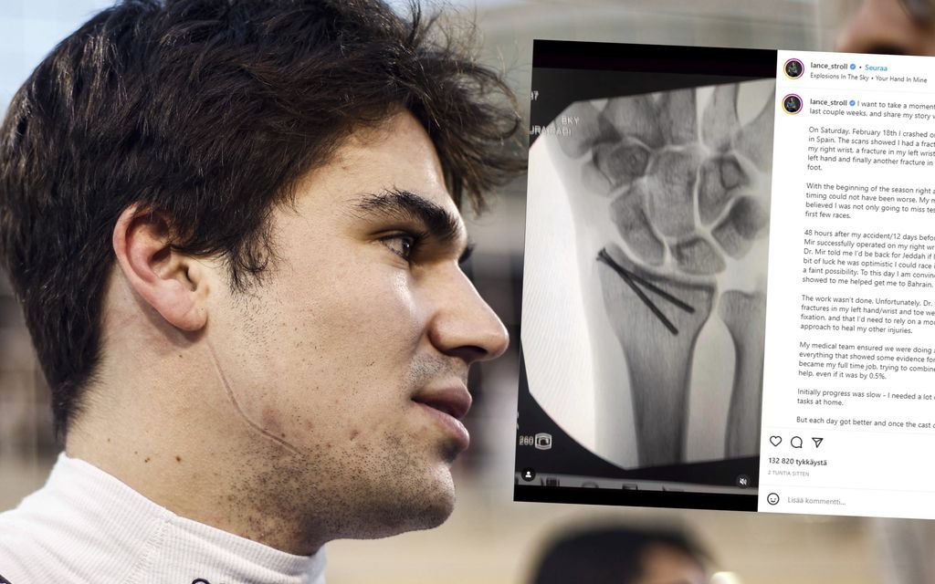 F1-kuski julkaisi rujoja kuvia vammoistaan – Röntgenkuvat paljastivat vakavuuden: ”Tarvitsin paljon apua”