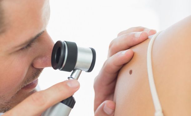 Suomessa todetaan vuosittain noin 1 100 uutta melanoomatapausta.