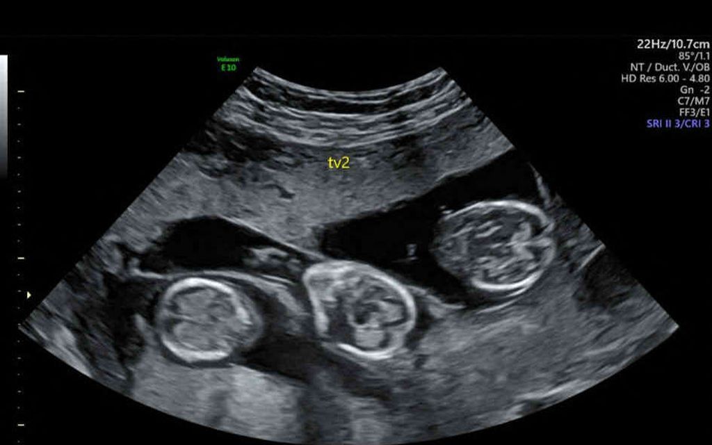 Hedelmöitys­klinikalla kävi karmiva moka Yhdysvalloissa