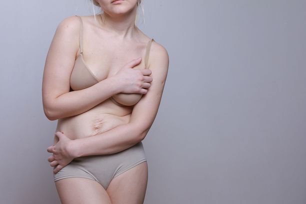– Laihduttaminen oli yleistä etenkin 30–39-vuotiailla, henkilöillä, joilla oli paljon ylipainoa, sekä korkeasti koulutetuilla, kertoo väitöskirjassaan laihduttamista tutkinut Laura Sares-Jäske.