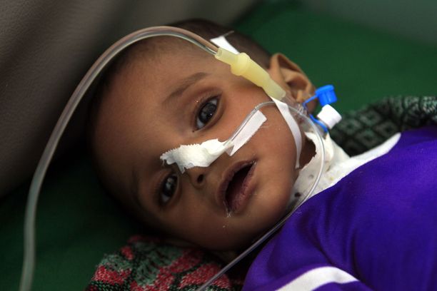 Jemenissä 1,8 miljoonaa alle viisivuotiasta lasta kärsii akuutista aliravitsemuksesta, kertoo Unicef.