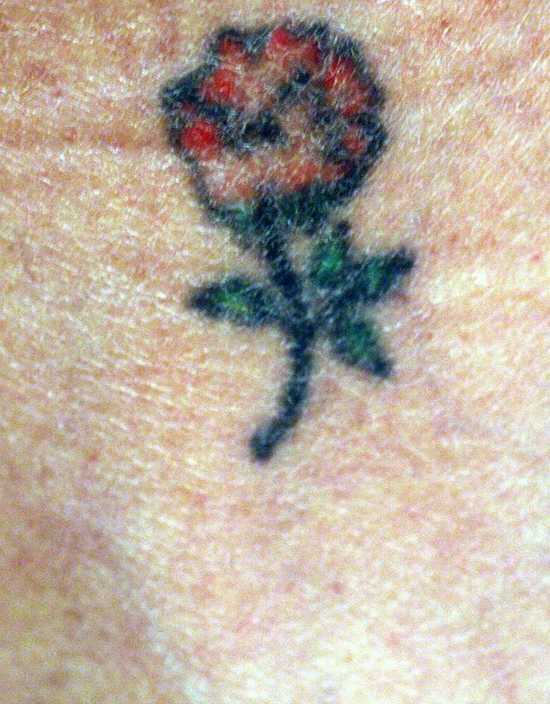 Tatuointi ei ole enää ikuinen - näin se häviää iholta