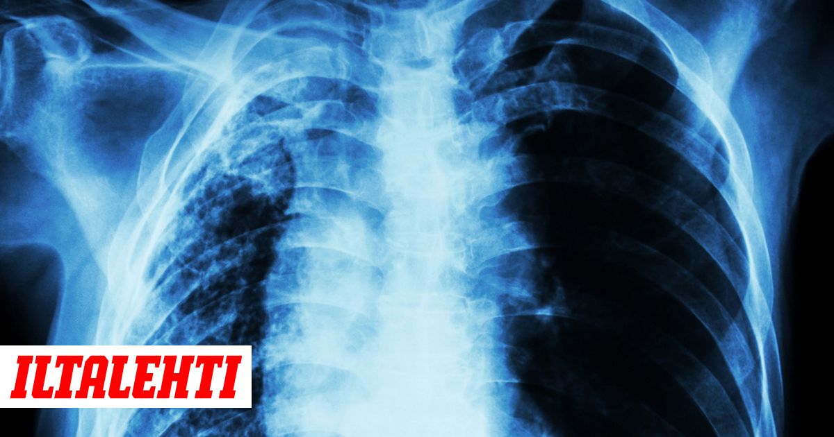 Keuhkokuume altistaa sydämen vajaatoiminnalle