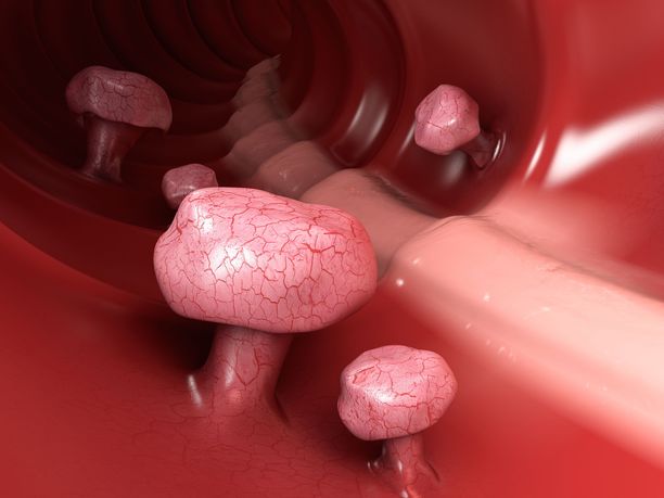 Kuvassa 3D-esitys suoliston polyypeista. Suolistosyöpään sairastuu vuosittain noin 2500 suomalaista.