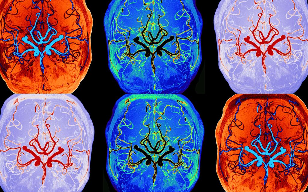 Aivojen salaisuus paljastui – Näin toimii uusi suomalais­keksintö