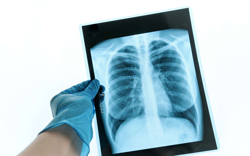 Koronavirus voi tehdä keuhkoille jotain odottamatonta – Tutkimus löysi yhteyden