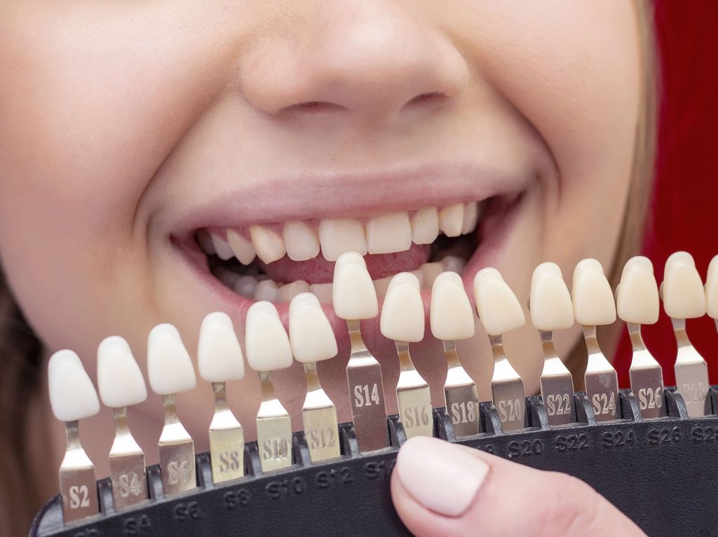 Valkaisun tulos riippuu myös omasta hampaasta ja sen lähtöväristä.