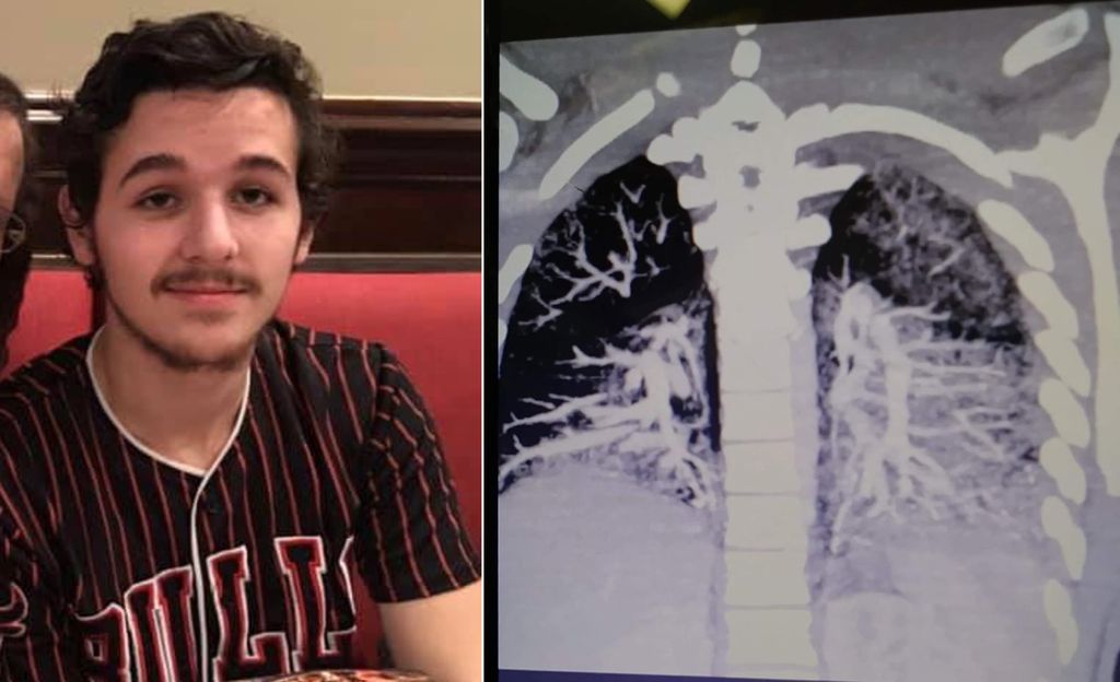 Sähkötupakkaa käyttäneen Anthonyn, 19, röntgenkuvat paljastivat: Keuhkot kuin kuusikymppisellä ketjupolttajalla