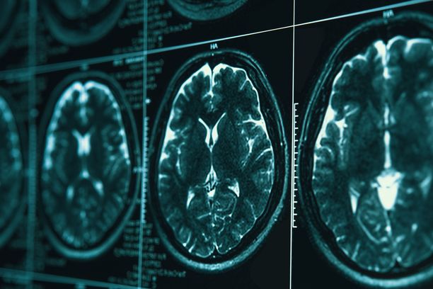 Alzheimerin taudin edetessä aivokuvissa voi näkyä monenlaisia muutoksia.