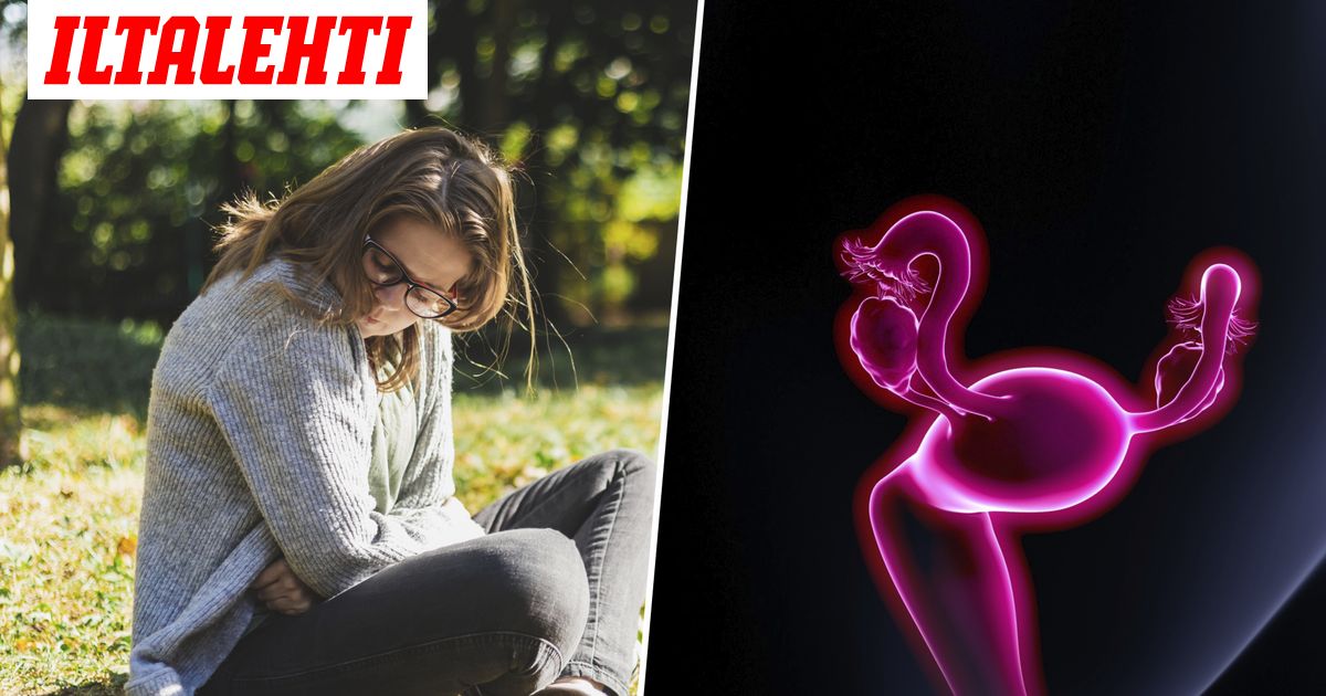 Tutkijat tekivät läpimurron myooma koskettaa kymmeniätuhansia