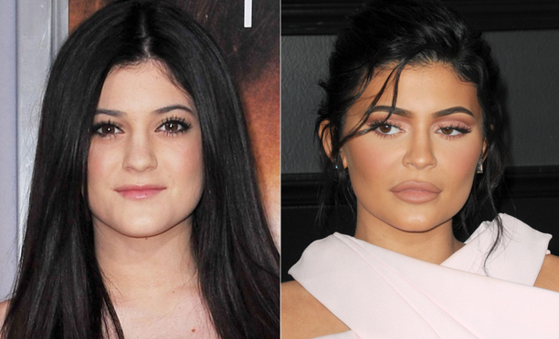 Kylie Jenner on kokenut huiman muodonmuutoksen. Plastiikkakirurgin mielestä hän näyttää ikäistään vanhemmalta. Vasemmanpuoleisessa kuvassa Kylie on kuvattuna vuonna 2012.