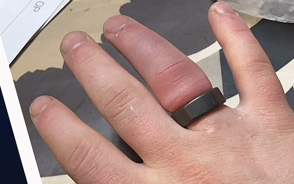 Oura-sormus jumittui Aapon sormeen – video irrottamisesta voitti 500 euroa