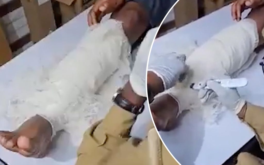 Miehen jalka herätti huomion intialaisella lentokentällä – Kipsin alta paljastui yllättävä löytö