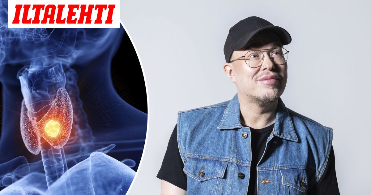 Kilpirauhasen vajaatoiminta oireet ja hoito