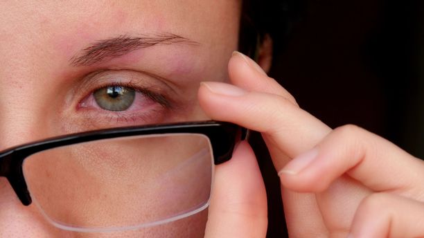 Silmien punoitus on yksi kuivasilmäisyyden oire.